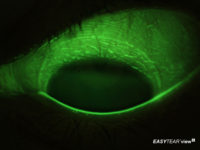 Conjunctiva staining after SiH contact lens wear